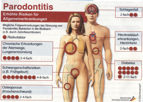 Infografik zu Parodontitis: erhöhte Risiken für Allgemeinerkrankungen wie Schlaganfall, Herz-Kreislauf-Erkrankungen und Herzinfarkt, Diabetes, chronische Atemwegserkrankungen, Schwangerschaftsrisiken und Osteoporose