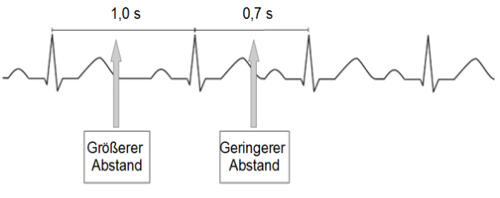 EKG-Kurve mit markierten Abständen zwischen den Herzschlägen: ein größerer Abstand von 1,0 Sekunden und ein geringerer Abstand von 0,7 Sekunden